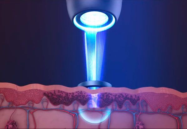 tratamiento facial arrugas