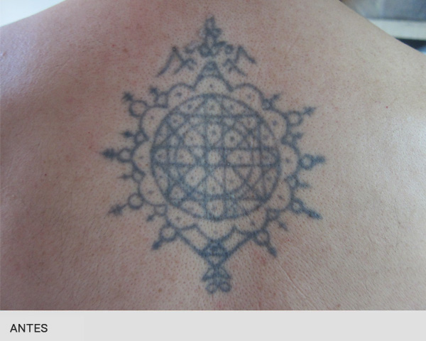 borrar tatuajes antes