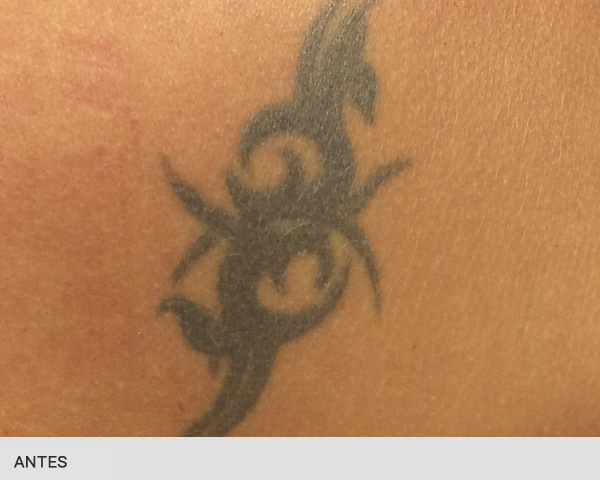 eliminar tatuajes Barcelona antes