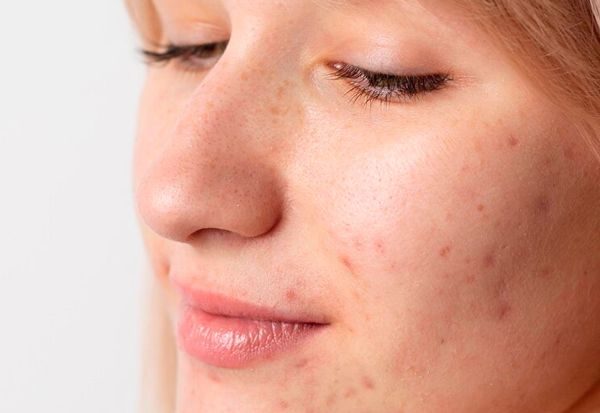 cicatrices post acne