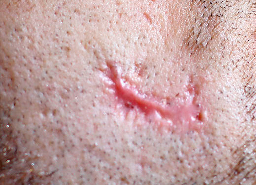 cicatrices atróficas