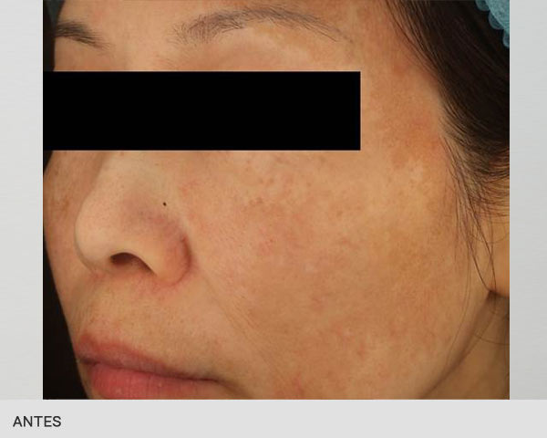 luminosidad_picoway_antes_ribe_clinic