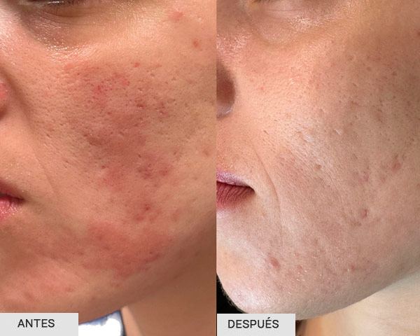 Antes y después tratamiento acné