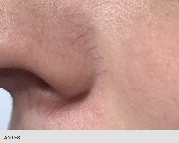 antes y despues cuperosis laser vascular nariz
