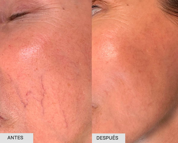 antes y despues cuperosis cara