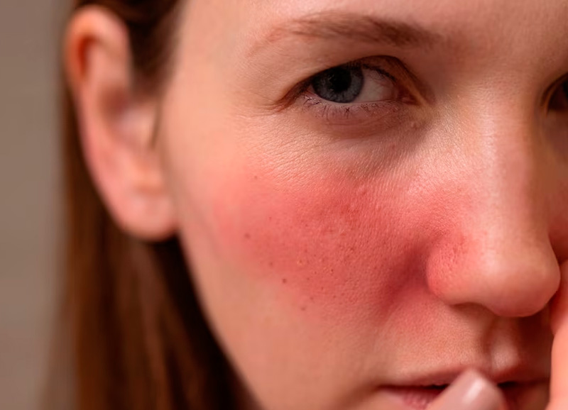cuperosis facial