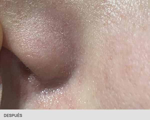 antes despues cuperosis laser vascular nariz