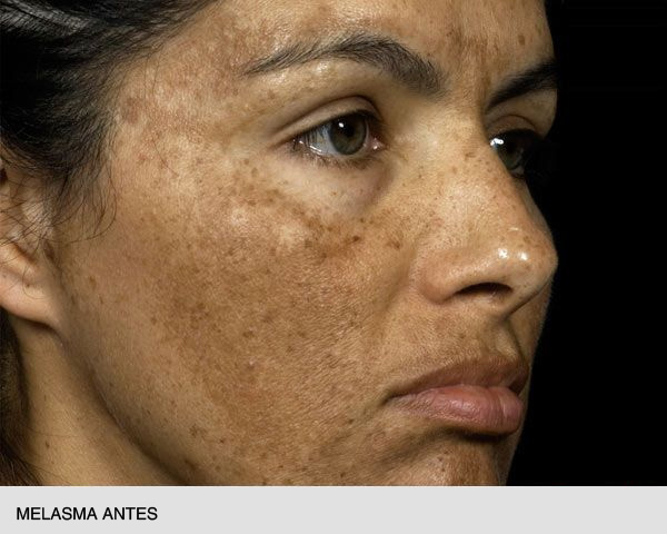 Fraxel melasma antes
