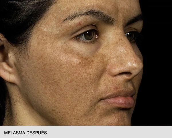 Fraxel melasma después
