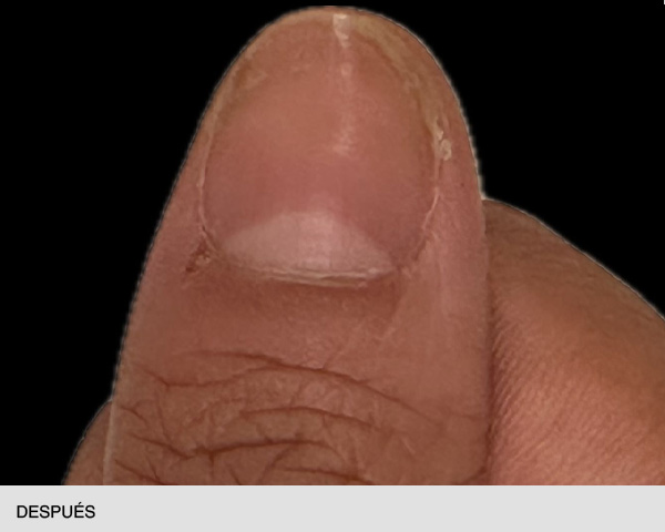 Laser para hongos en las uñas antes y después