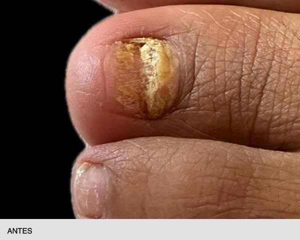 Laser para onicomicosis en-las-uñas antes y después