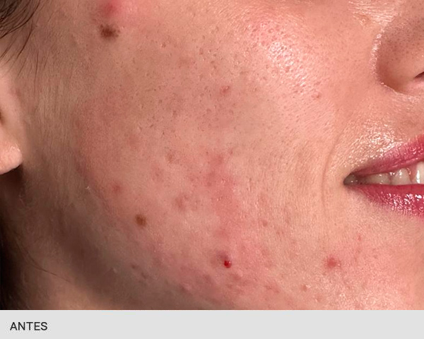 eliminar cicatrices con laser