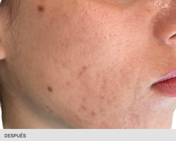 eliminar cicatrices con laser antes y después
