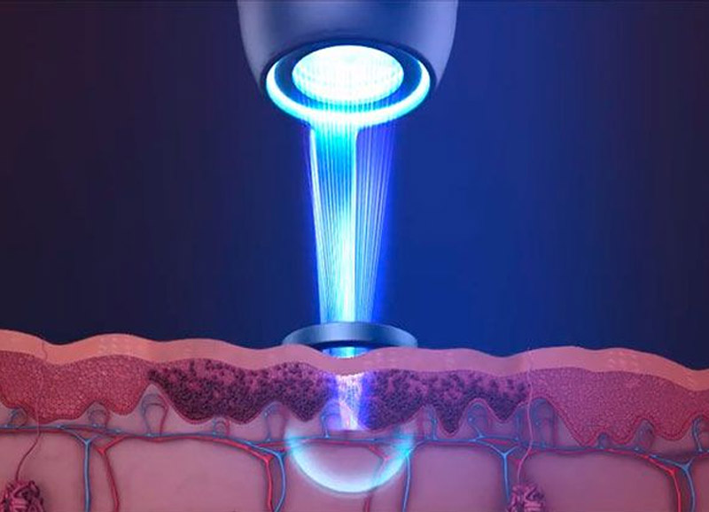cicatrices laser picosegundos