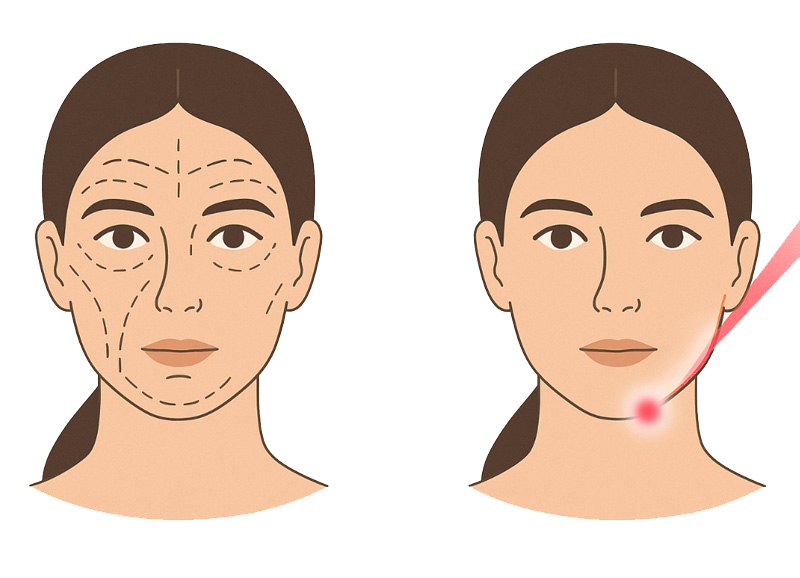 diferencias lifting endolift