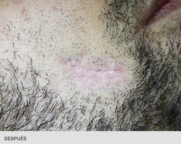 laser para cicatrices antes y después