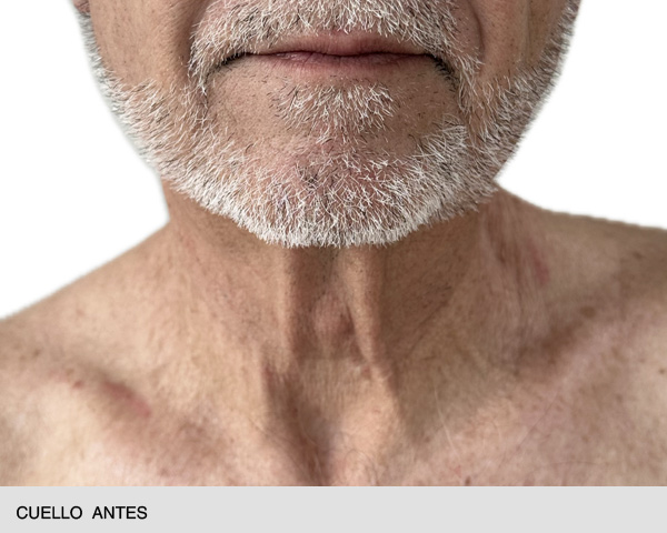 Endolift cuello antes y después