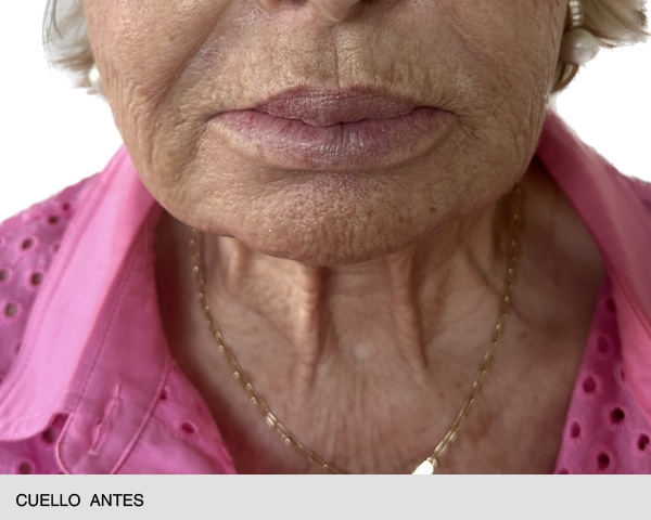 endolift cuello mujer antes y después
