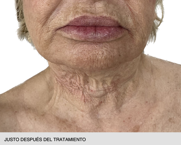 endolift cuello mujer antes y después