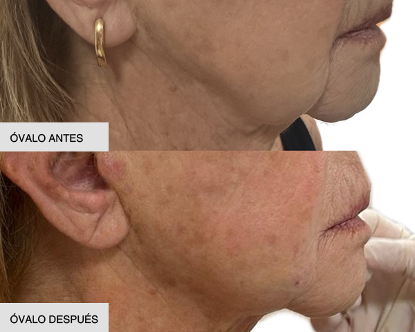 Endolift óvalo facial antes y después