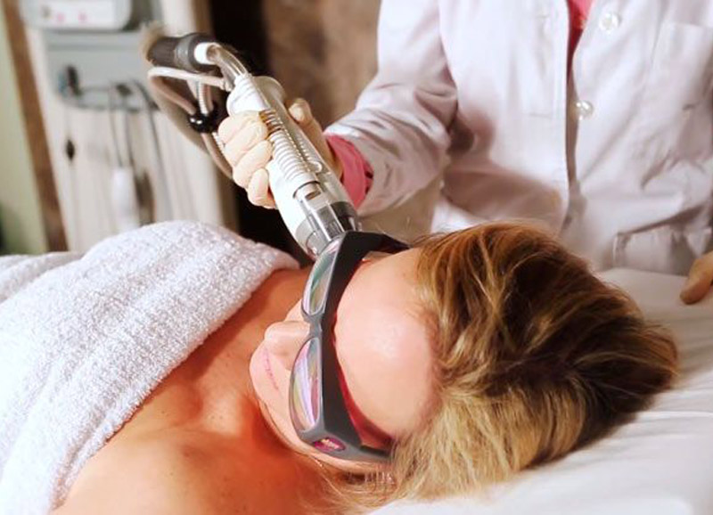 laser para cicatrices