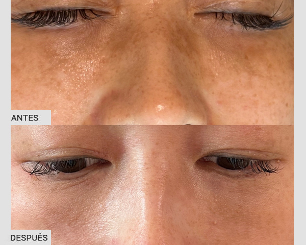 antes después melasma laser picosegundos