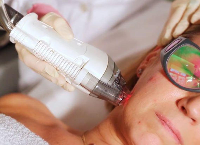 laser fraxel melasma