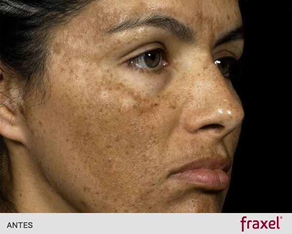 quitar manchas cara laser antes