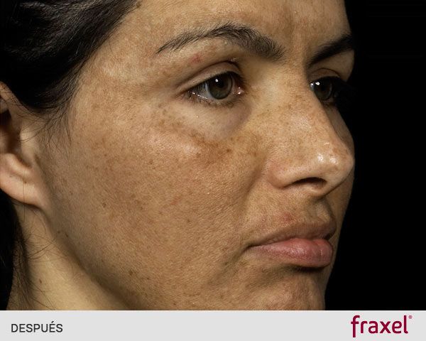 quitar manchas cara laser después