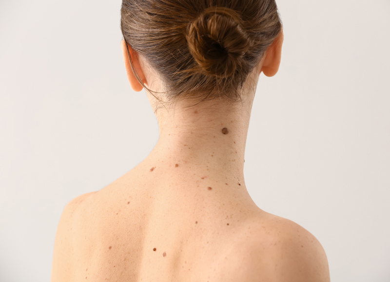manchas nevus