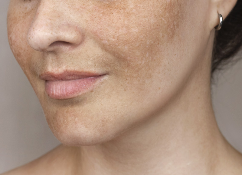 melasma facial