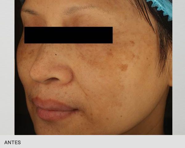 Eliminar melasma con Picosegundos