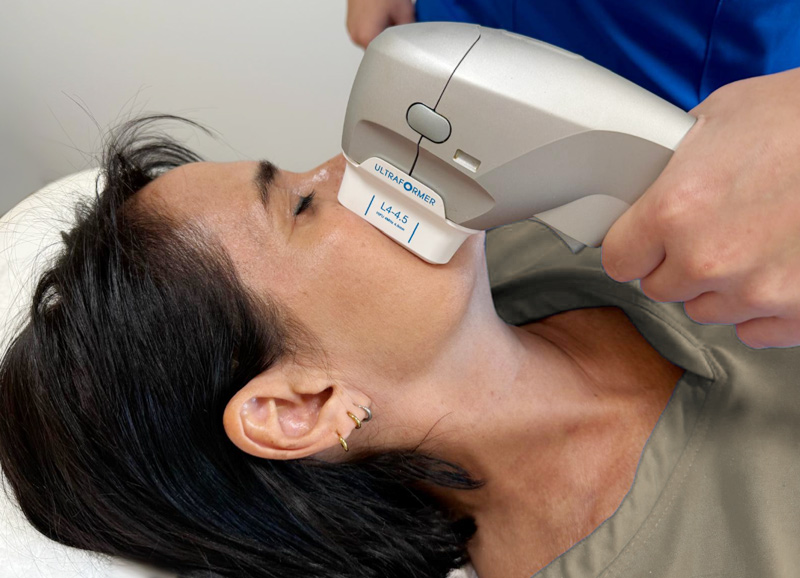hifu facial