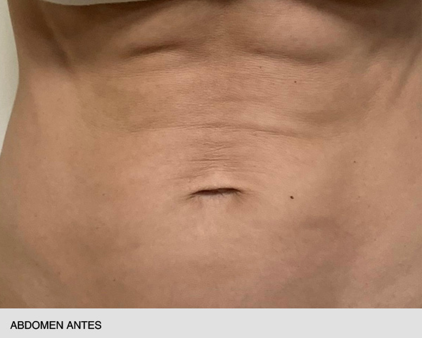 hifu abdomen antes