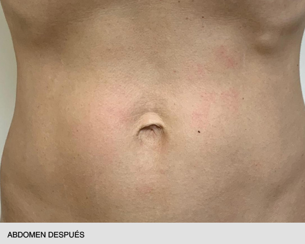 hifu abdomen después