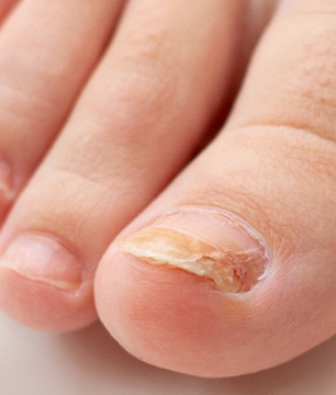 tratamientos de dermatología para hongos en las uñas