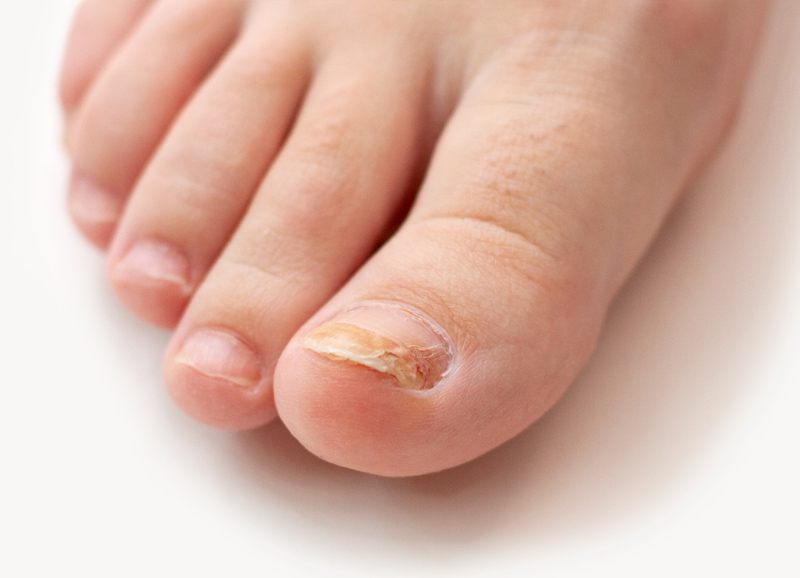 onicomicosis tratamiento uñas