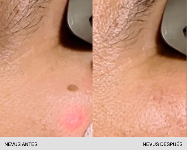 quitar nevus antes y después