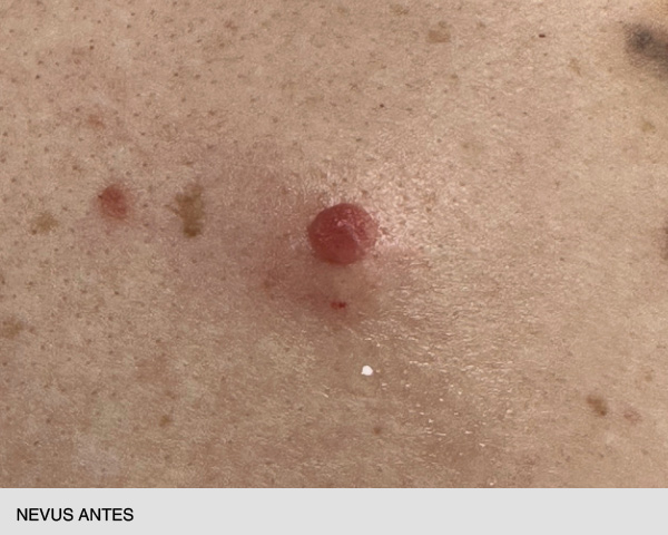 quitar nevus antes