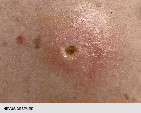 quitar nevus después