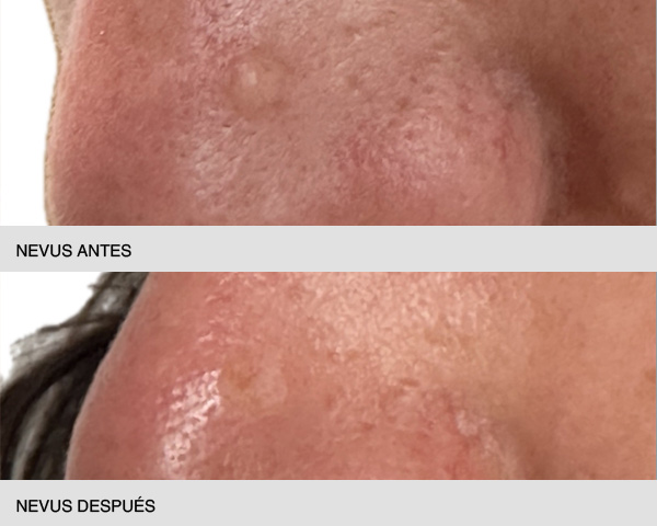 quitar nevus intradérmico antes y después