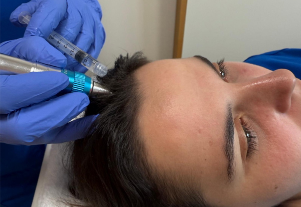 tratamiento capilar con exosomas