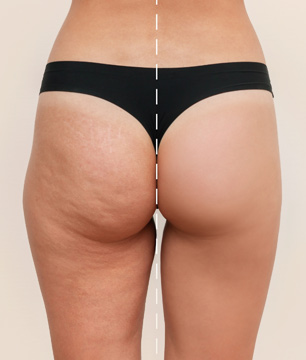 tratamiento corporal de celulitis