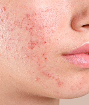 tratamientos de dermatología para acné