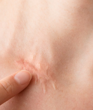 tratamientos de dermatología para cicatrices