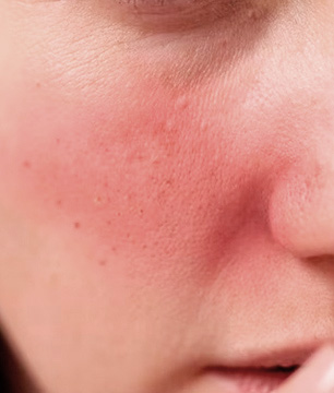 tratamiento vasculares para cuperosis