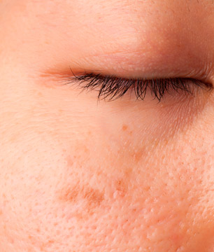 tratamientos de dermatología para manchas