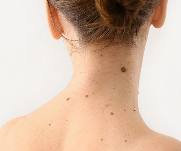 tratamientos faciales nevus