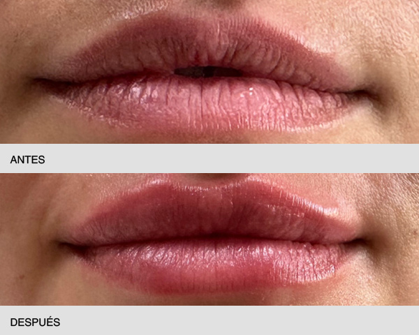 Acido hialurónico labios antes y después