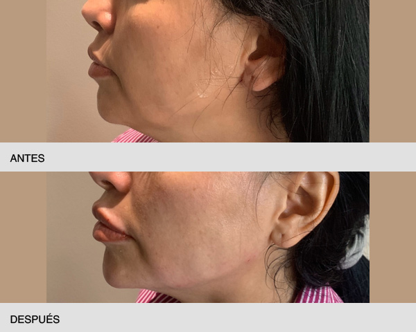 Ácido hialurónico óvalo facial antes y después